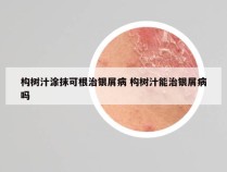 构树汁涂抹可根治银屑病 构树汁能治银屑病吗