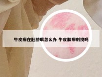 牛皮癣在肚脐眼怎么办 牛皮肤癣刺挠吗