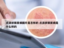 点滴状银屑病图片是怎样的 点滴状银屑病是什么样的