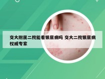 交大附属二院能看银屑病吗 交大二院银屑病权威专家