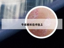 牛皮癣长在手肚上