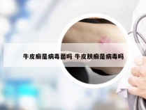 牛皮癣是病毒菌吗 牛皮肤癣是病毒吗
