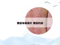 腰部体癣图片 腰部的藓