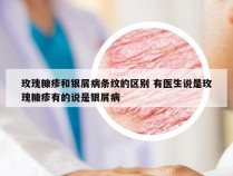 玫瑰糠疹和银屑病条纹的区别 有医生说是玫瑰糠疹有的说是银屑病
