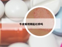 牛皮癣初期起红疹吗