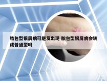 脓包型银屑病可继发出现 脓包型银屑病会转成普通型吗