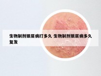 生物制剂银屑病打多久 生物制剂银屑病多久复发