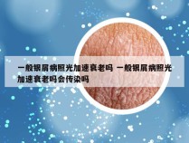一般银屑病照光加速衰老吗 一般银屑病照光加速衰老吗会传染吗