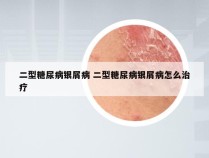 二型糖尿病银屑病 二型糖尿病银屑病怎么治疗