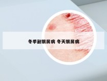冬季副银屑病 冬天银屑病