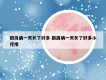 银屑病一天长了好多 银屑病一天长了好多小疙瘩