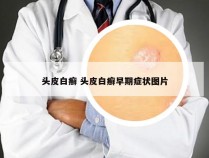头皮白癣 头皮白癣早期症状图片