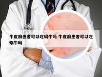 牛皮癣患者可以吃蜗牛吗 牛皮癣患者可以吃蜗牛吗