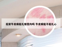 后背牛皮癣能扎椎管内吗 牛皮癣能不能扎心