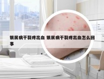 银屑病干裂疼出血 银屑病干裂疼出血怎么回事