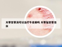 大枣甘草汤可以治疗牛皮癣吗 大枣加甘草泡水