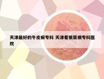 天津最好的牛皮癣专科 天津看银屑病专科医院