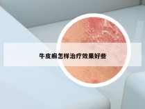 牛皮癣怎样治疗效果好些