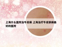 上海什么医院治牛皮癣 上海治疗牛皮肤癣最好的医院