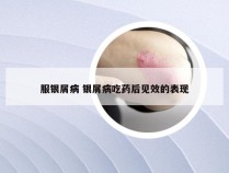 服银屑病 银屑病吃药后见效的表现