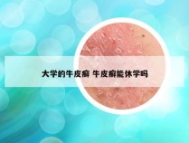 大学的牛皮癣 牛皮癣能休学吗