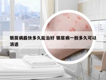银屑病最快多久能治好 银屑病一般多久可以消退