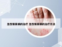 急性银屑病的治疗 急性银屑病的治疗方法