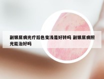副银屑病光疗后色变浅是好转吗 副银屑病照光能治好吗