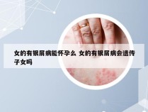女的有银屑病能怀孕么 女的有银屑病会遗传子女吗