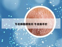 牛皮癣胳膊有印 牛皮癣手肘
