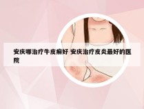 安庆哪治疗牛皮癣好 安庆治疗皮炎最好的医院