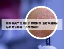 银屑病关节型用什么生物制剂 治疗银屑病引起的关节疼用什么生物制剂