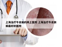 上海治疗牛皮癣的网上医院 上海治疗牛皮肤癣最好的医院