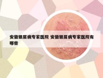 安徽银屑病专家医院 安徽银屑病专家医院有哪些