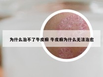 为什么治不了牛皮癣 牛皮癣为什么无法治愈