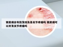 银屑病会导致发烧及各关节疼痛吗 银屑病可以并发关节疼痛吗