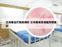 兰州哪治疗银屑病好 兰州看银屑病医院哪里好
