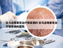 驻马店哪里有治疗银屑病的 驻马店哪里有治疗银屑病的医院