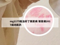 mg2175瓶治好了银屑病 银屑病2017成功新药