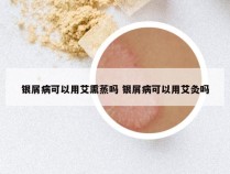银屑病可以用艾熏蒸吗 银屑病可以用艾灸吗