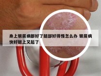 身上银屑病都好了腿部好得慢怎么办 银屑病快好腿上又起了