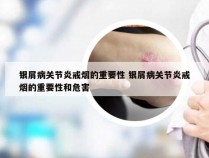 银屑病关节炎戒烟的重要性 银屑病关节炎戒烟的重要性和危害