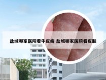 盐城哪家医院看牛皮癣 盐城哪家医院看皮肤
