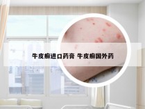 牛皮癣进口药膏 牛皮癣国外药