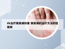 Vk治疗银屑病效果 银屑病的治疗方法的短视频
