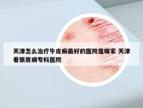 天津怎么治疗牛皮癣最好的医院是哪家 天津看银屑病专科医院