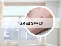 牛皮癣病是怎样产生的