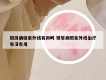 银屑病做紫外线有用吗 银屑病照紫外线治疗有没有用