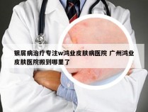 银屑病治疗专注w鸿业皮肤病医院 广州鸿业皮肤医院搬到哪里了