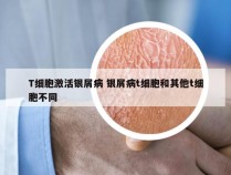 T细胞激活银屑病 银屑病t细胞和其他t细胞不同